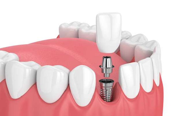 Dental Implant