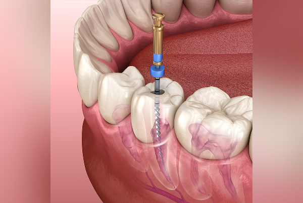 Painless Root Canal Treatment