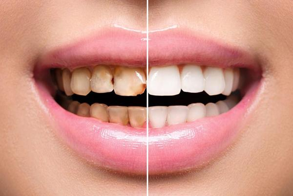 Dental Veneers and Laminates