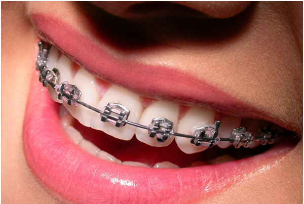 Dental Braces