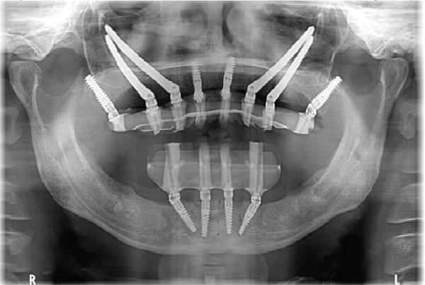 Zygomatic Implants