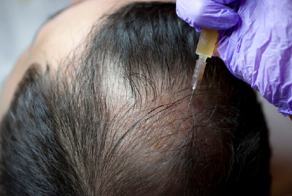 Hair PRP Treatment