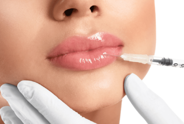 chemical peel treatment