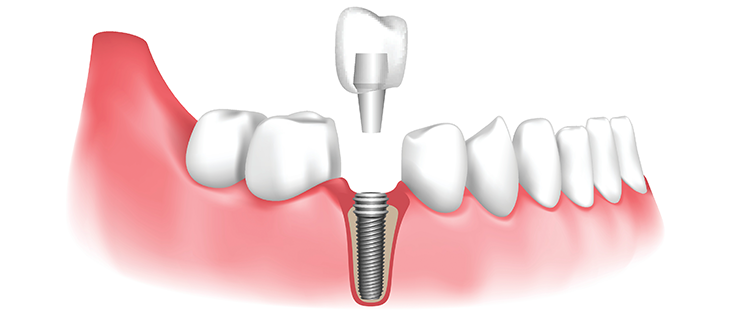 Tooth Implant