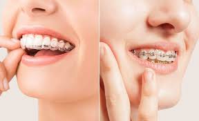 The Smile Upgrade Most People Don't Know They Need